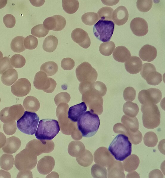 File:Lymphoblasts in acute lymphoblastic leukemia.jpg