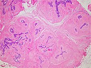 Micrograph of a fibroadenoma.jpg