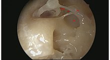 Sinus tympani: An area of the tympanic cavity that is hidden from microscope Sinus tympani.jpg