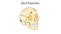 Skull fractures