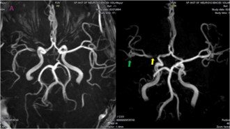 Middle cerebral artery angiography, showing stenosis TOF MRI angiography of right middle cerebral artery stenosis.png