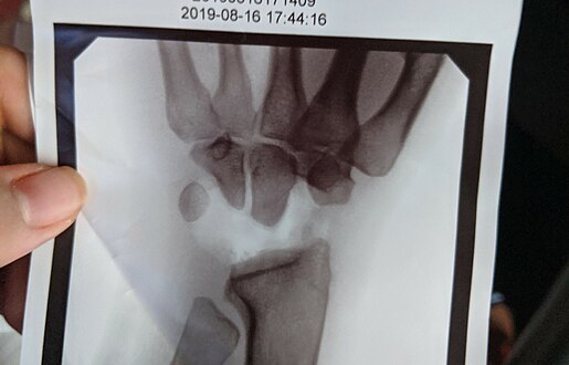 X-Ray on Left Hand Post-Proximal Row Carpectomy, in Traction.