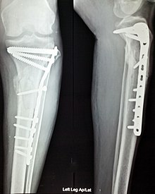 An x-ray of intramedullary nailing in a tibial fracture X ray internal fixation leg fracture.jpg