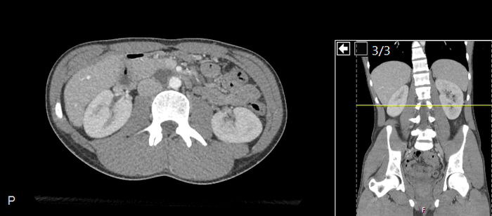CT of a normal abdomen and pelvis, axial plane 118.png