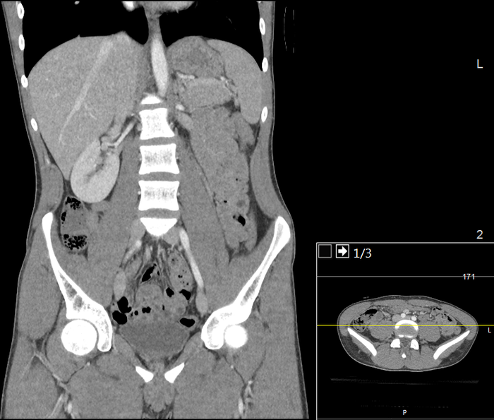 CT of a normal abdomen and pelvis, coronal plane 68.png