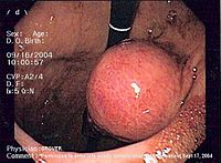 Endoscopic image of GIST in fundus of stomach, seen on retroflexion. GIST 2.jpg