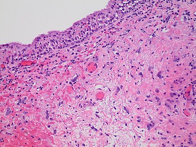 squamous cell carcinoma bladder gross