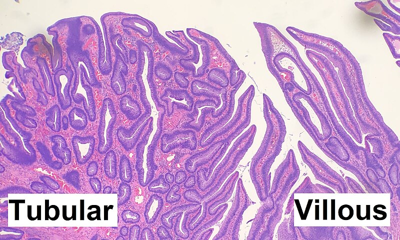 File:Histopathology of tubulovillous adenoma.jpg