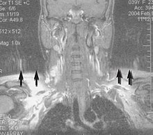 Motion artifact (T1 coronal study of cervical vertebrae) MRI with motion artifacts.jpg