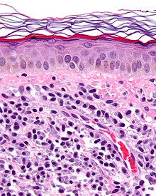 ביופסיית עור של מסטוציטוזיס