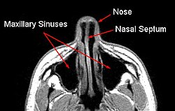 Макрилярлық синус MRI.jpg