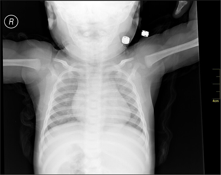 File:Medical X-Ray imaging BII02 nevit.jpg