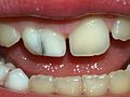 Слияние двух молочных зубов
