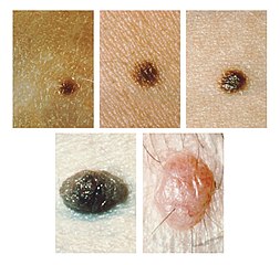 moles warts cured chicken pox shingles