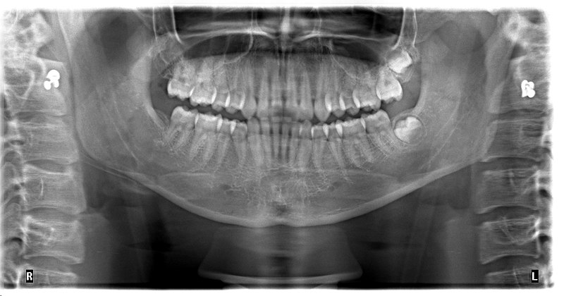 File:Orthopantomogram of missing eight side wisdom teeth in upper and lower arches.jpg