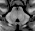 MRI section of human mid-brain showing periaqueductal gray