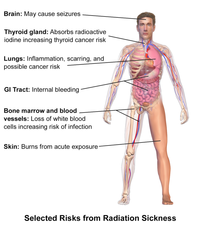 急性辐射综合征 Wikiwand