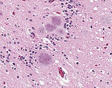 The brains of affected animals show characteristic spongy plaques. Variant Creutzfeldt-Jakob disease (vCJD), typical amyloid plaques, H&E.jpg