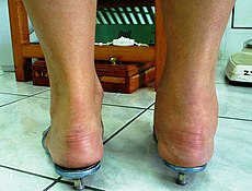 Ankle Joint Arthritis.jpg