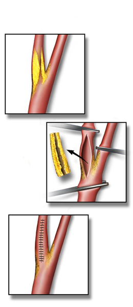 Blausen 0172 CarotideEndartériectomie.png