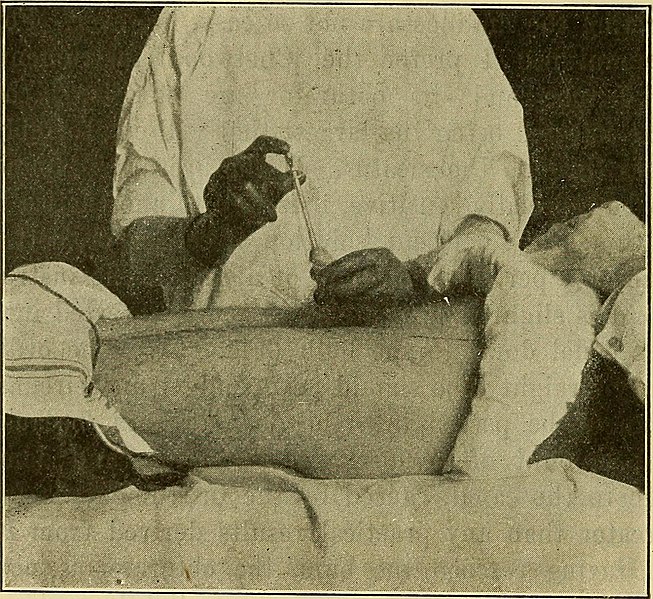 File:Gonorrhea in the male - a practical guide to its treatment (1911) (14593281490).jpg