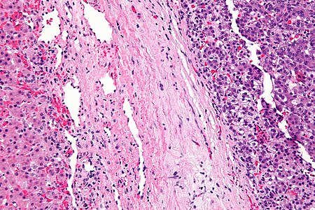 Tập_tin:Hepatoblastoma_-_high_mag.jpg