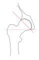 Transverse angle of acetabular inlet plane