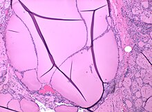 Histopathology of a colloid nodule of the thyroid, showing dilated thyroid follicles. There is some reactive fibrosis (at right) but no consistent capsule. Histopathology of thyroid colloid nodule.jpg