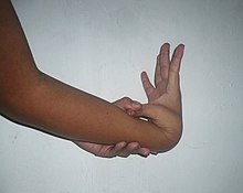 Hyperextension of the hand Hypermobility-02.jpg