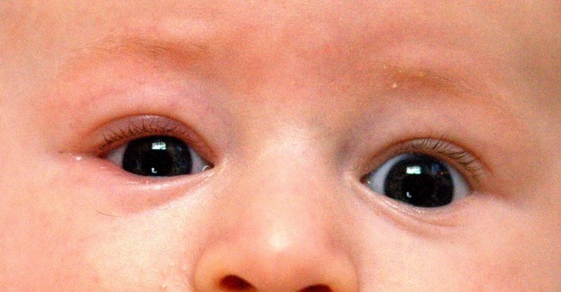 File:Infant with blepharitis on the right side.jpg