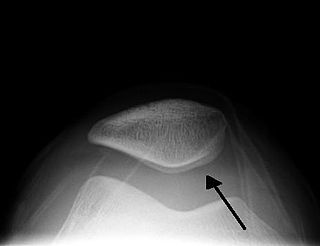 <span class="mw-page-title-main">Patellar tap</span>