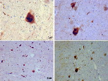 external image 220px-Lewy_bodies_%28alpha_synuclein_inclusions%29.svg.png