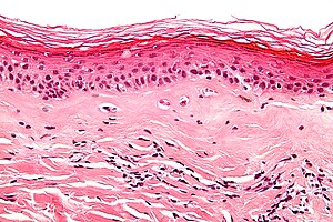 Мікрофотознімок субепітеліального склерозу (середня третина знімку). ГЕ