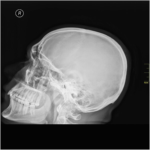 File:Medical X-Ray imaging PVS06 nevit.jpg