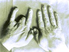 Radiační nekróza prstů ruky – v minulosti byla typická u radiologů