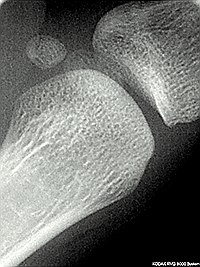 Radiographie de l'articulation du pouce (métacarpe 1-phalange proximale) et des os sésamoïdes.jpg