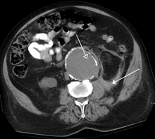A CT scan image showing a ruptured abdominal aortic aneurysm. RupturedAAA.png