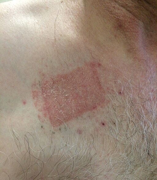 Severe contact dermatitis buprenorphine transdermal patch