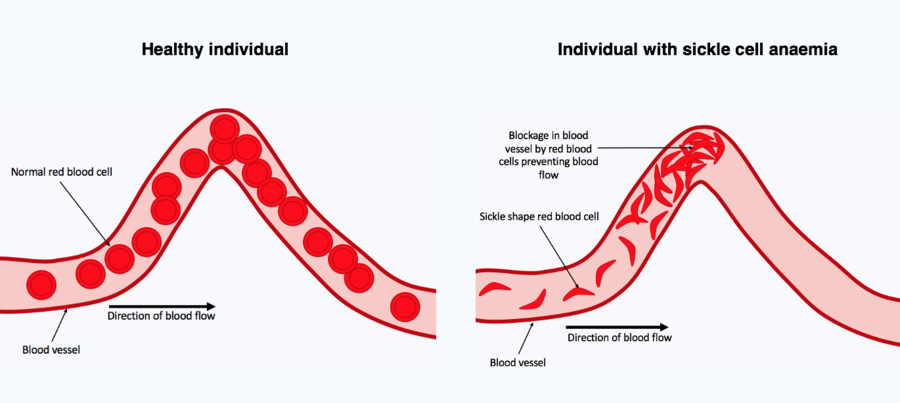 A comparison between a healthy individual and a sufferer of sickle cell anaemia illustrating the different red blood cell shapes and differing blood flow within blood vessels.