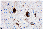 Vorschaubild für Tauopathie