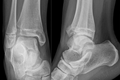 Tillaux fracture