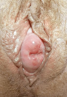 Наружный маточный зев шейки матки в просвете половой щели между половыми губами