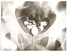 Vasography with a prostatic cyst and seminal vesicles filled with iodinated contrast Vasography 2.jpg