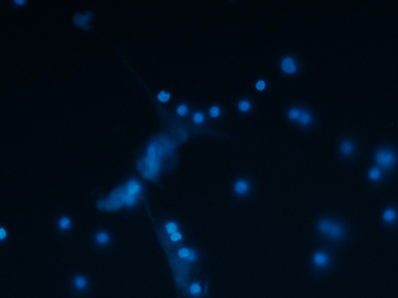 File:Agregation of neutrophils around spontaneously activated netosis observed in Alzheimers' Desease patients blood.jpg