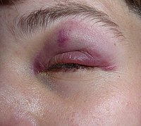 A black eye, a common facial injury. Black eye (2).jpg