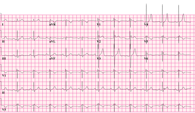 File:Brugada syndrome type2 example1 (CardioNetworks ECGpedia).png