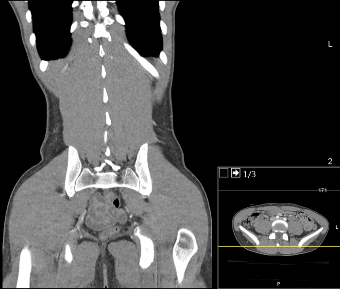 CT of a normal abdomen and pelvis, coronal plane 114.png