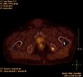 Fusionsbild aus CT und Cholin-PET der Prostatakrebs-Metastase im linken Schambein