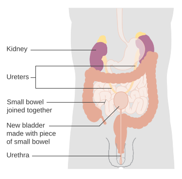 File:Diagram showing bladder reconstruction CRUK 111.svg