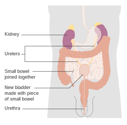 Surgical reconstruction (neobladder) of the bladder following removal.